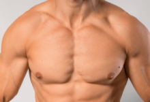 Gynecomastia